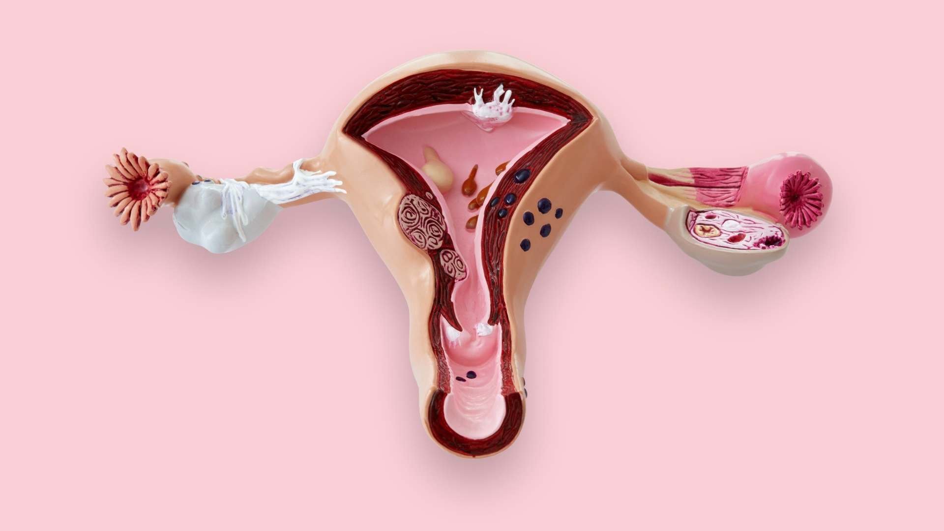 Quistes En El Ovario Causas Síntomas Y Tratamiento 9102